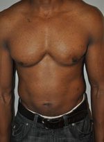 Gynecomastia Before and After Results New York City