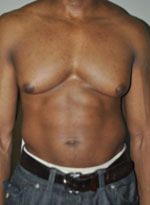 Gynecomastia Before and After New York City