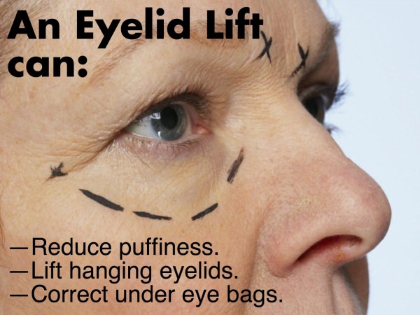 NYC Eyelid Lift Surgery - Blepharoplasty
