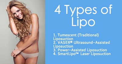 Types of Liposuction | Manhattan, New York City | Cosmetic Surgery