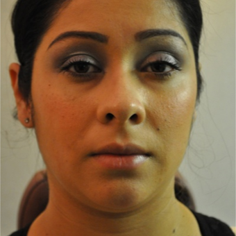 Buccal Fat Removal Before Photo