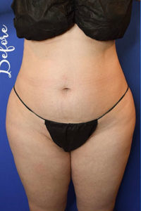 Liposuction Results New York City