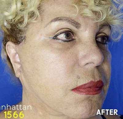 Neck Lift and Face Lift