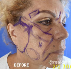 Facelift Results New York City