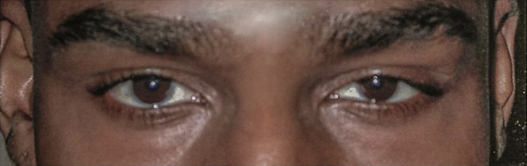Before & After Droopy Eyelid Treatment