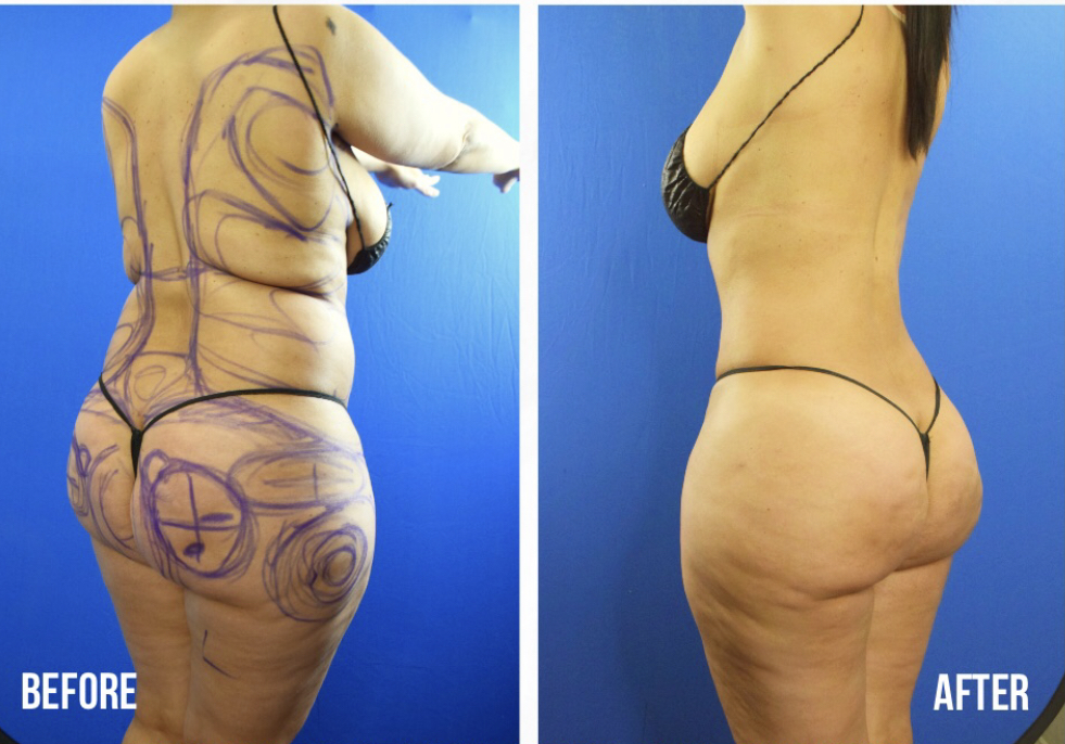 Lipo 360 Before and After Photo