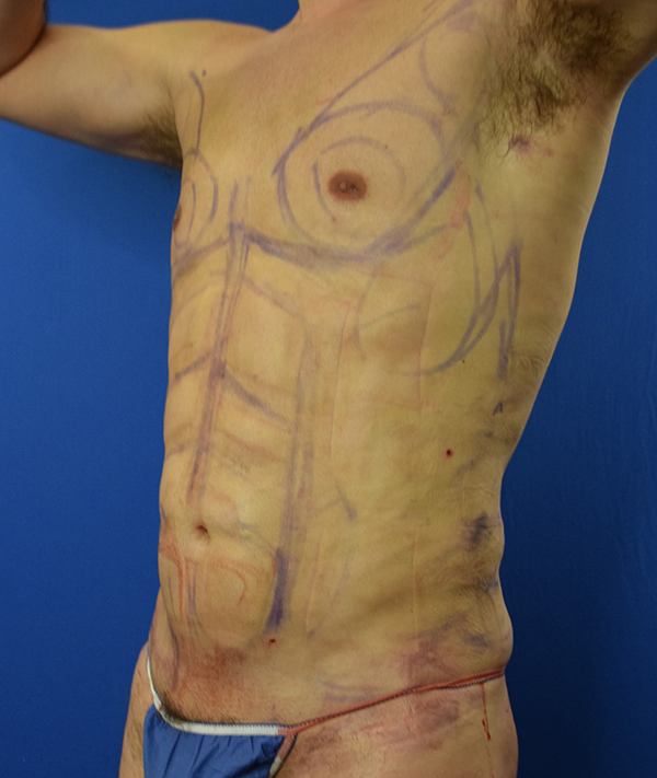 Gynecomastia