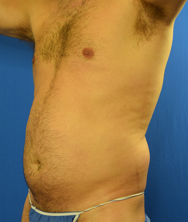 Gynecomastia