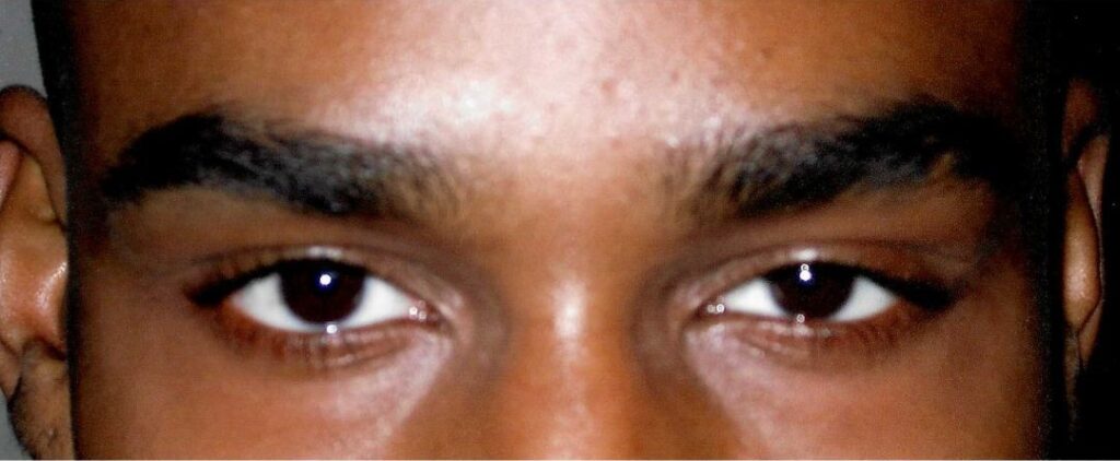 Male pre-op blepharoplasty