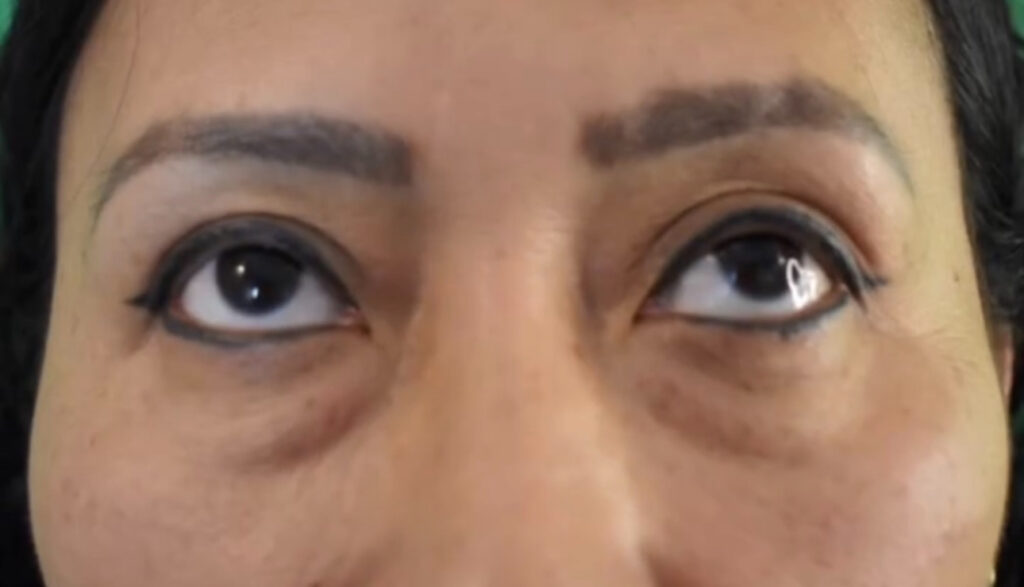 Female patient pre-operative lower and upper blepharoplasty