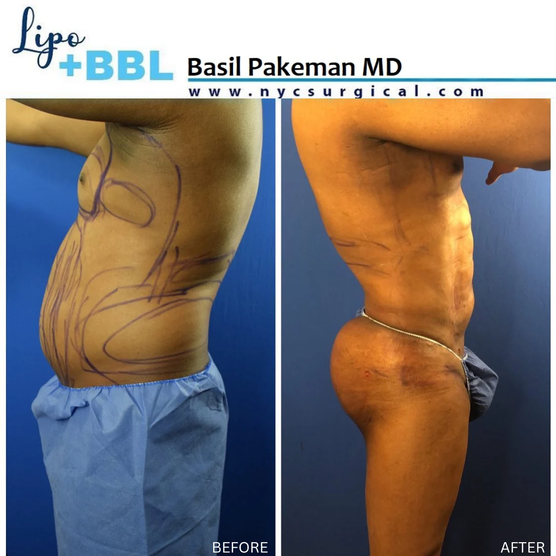 MALE BBL before and after