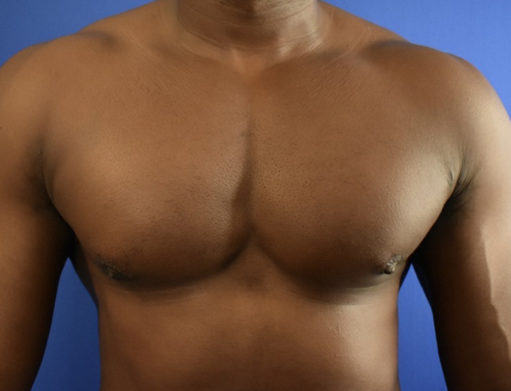 gynecomastia after photo