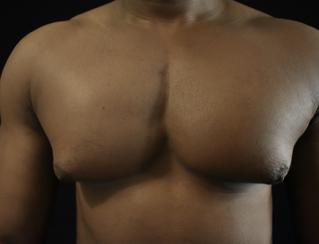 gynecomastia before photo