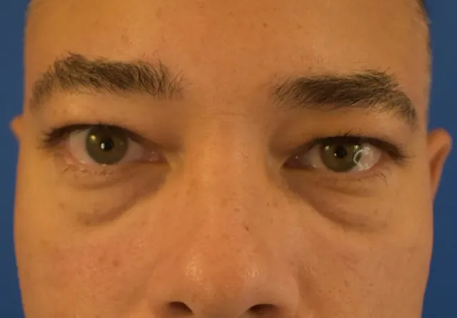 male eyelid surgery before photo